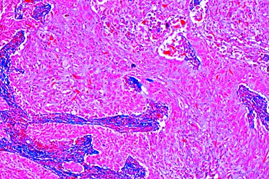 Mikropr Parat Karzinom Am Hals Der Geb Rmutter Carcinoma Cervicis Uteri