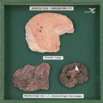 Objektkasten Raucherlunge, Lungenkarzinom und gesunde Lunge Objektkasten Raucherlunge, Lungenkarzinom und gesunde Lunge