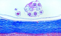 Mikropräparat - Echinococcus granulosus, Zystenwand (Hydatide) mit Tochterblasen und Scolices, quer