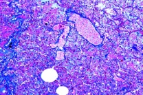 Mikropräparat - Embolische, nicht eitrige Glomerulonephritis