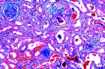 Mikropräparat - Chronische Glomerulonephritis