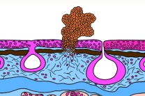 Mikropräparat - Schleimhautgeschwür eines Lurches als Folge von Wasserverschmutzung Mikropräparat - Schleimhautgeschwür eines Lurches als Folge von Wasserverschmutzung