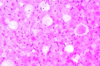 Mikropräparat - Schweinerotlauf, Bacterium erysipelatos, Bakterienausstrich