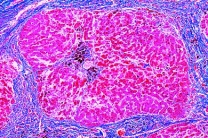 Mikropräparat - Pigmentzirrhose der Leber, Krankhafte Veränderungen der Zellen und Gewebe