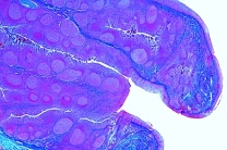 Mikropräparat - Mandelentzündung, Tonsillitis, Krankhafte Veränderungen der Zellen und Gewebe