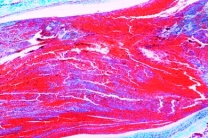 Mikropräparat - Organisierte Venenthrombose im Wadenmuskel, Schädigungen der Kreislauforgane (Herz, Gefäße) und der blutbildenden Organe