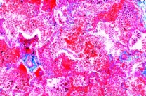 Mikropräparat - Hämorrhagischer Infarkt in der Lunge, Pathologische Veränderungen der Lunge und der Leber, Tuberkulose und Lungenentzündung