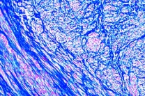 Mikropräparat - Gebärmuttermyom (Myoma uteri), Histologie der gut- und bösartigen Geschwülste