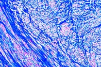 Mikropräparat - Gebärmuttermyom (Myoma uteri), Histologie der gut- und bösartigen Geschwülste Mikropräparat - Gebärmuttermyom (Myoma uteri), Histologie der gut- und bösartigen Geschwülste