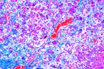 Mikropräparat - Lebermetastasen Mikropräparat - Lebermetastasen