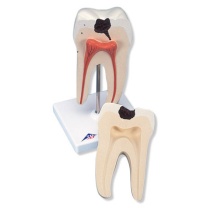Unterer zweiwurzeliger Molar mit Karies, 2-teilig