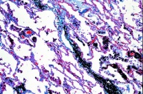 Mikropräparat - Lungenpathologie des Menschen: Normale Lunge, ...