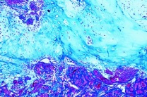 Mikropräparat - Fibroepithelialer Mischtumor der Parotis Mikropräparat - Fibroepithelialer Mischtumor der Parotis