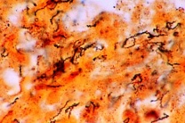 Mikropräparat - Konnatale Syphilis der Leber*