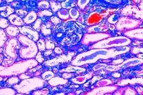 Mikropräparat - Amyloid-Degeneration der Niere (Amyloidose)