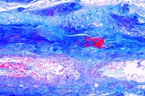 Mikropräparat - Balggeschwulst, Atheroma capitis