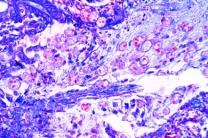 Mikropräparat - Entamoeba histolytica, Schnitt durch den erkrankten Dickdarm mit Parasiten in situ (Amöbenabszeß)