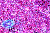 Mikropräparat - Malaria Melanämie in der Milz des Menschen, quer