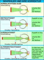 Digitale Folien auf CD, Sehfehler und ihre Korrektur