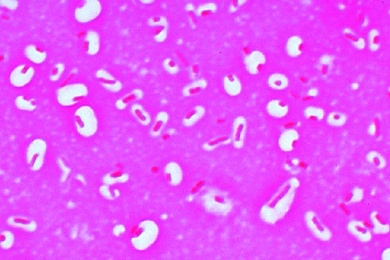 Mikropräparat - Klebsiella pneumoniae (Friedländer), Lungenentzündung, Ausstrich