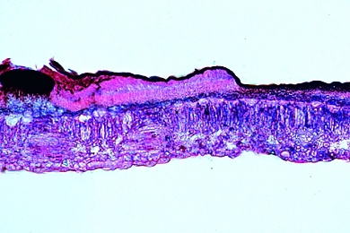 Mikropräparat - Ahornrunzelschorf (Rhytisma), befallenes Blatt, quer, Folge von Monokultur