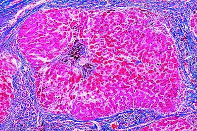 Mikropräparat - Pigmentzirrhose der Leber, Krankhafte Veränderungen der Zellen und Gewebe