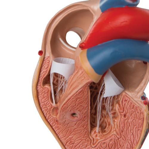 Klassik-Herz mit linksventrikulärer Hypertrophie (LVH), 2-teilig