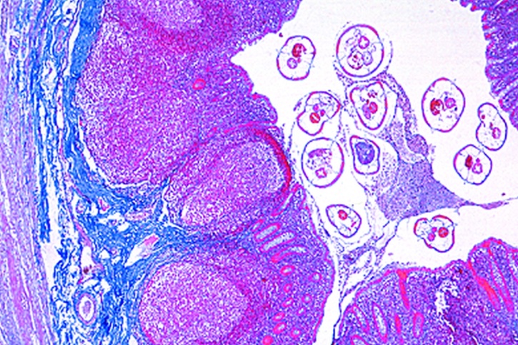 Mikropräparat - Enterobius vermicularis, Appendix des Menschen mit Madenwürmern in situ, quer