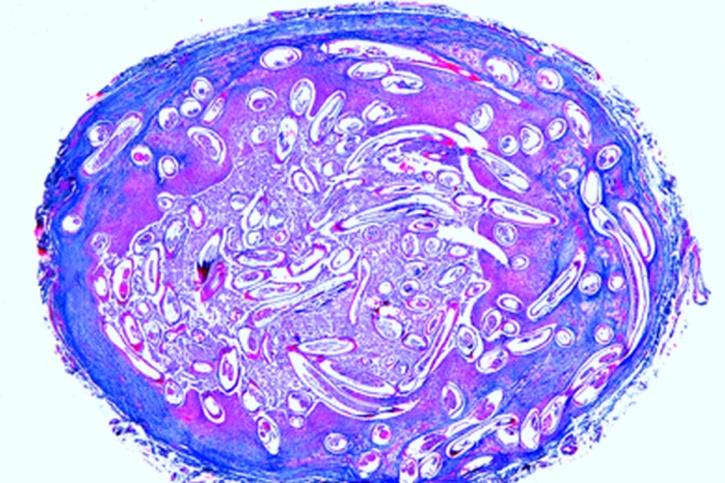 Mikropräparat - Onchocerca volvulus, Knäuelfilarie, Gewebeknoten, Schnitt