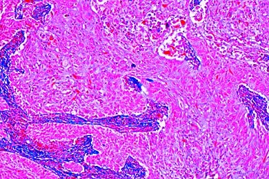 Mikropräparat - Karzinom am Hals der Gebärmutter, Carcinoma cervicis uteri
