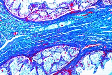Mikropräparat - Papilläres Ovarialkystom, Cystadenoma papilliferum ovarii