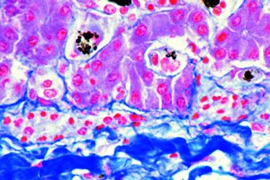 Mikropräparat - Plasmodium spec., exoerythrocytäre Formen in der Leber, Schnitt