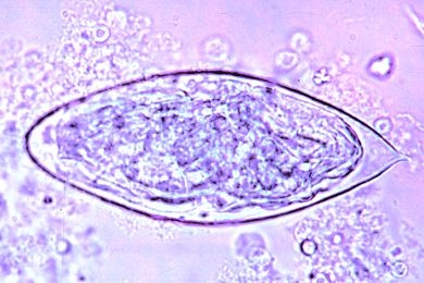 Mikropräparat - Schistosoma haematobium, Eier im Urinsediment