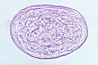 Mikropräparat - Schistosoma japonicum, Eier im Stuhl