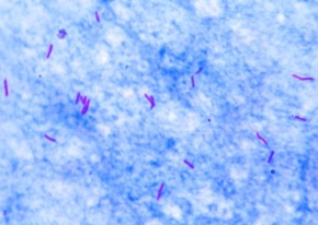 Mikropräparat - Mycobacterium tuberculosis, Ausstrich