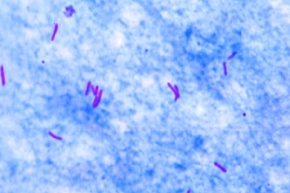 Mikropräparat - Mycobacterium tuberculosis, Ausstrich vom positiven Sputum, Färbung nach Ziehl-Neelsen