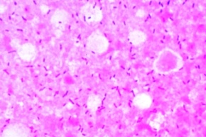 Mikropräparat - Bacterium erysipelatos, (Erysipelothrix rhusiopathiae) Rotlauferreger, Ausstrich