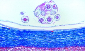 Mikropräparat - Echinococcus granulosus, Zystenwand (Hydatide) mit Tochterblasen und Scolices, quer