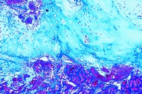 Mikropräparat - Fibroepithelialer Mischtumor der Parotis