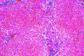 Mikropräparat - Parenchymatöse und fettige Degeneration der Leber