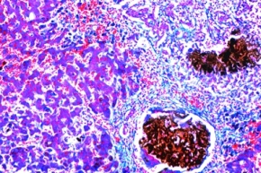 Mikropräparat - Stauungsikterus der Leber, Icterus hepatis