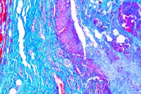 Mikropräparat - Nekrotisierende Oesophagitis