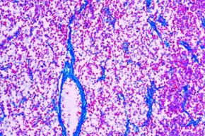 Mikropräparat - Hodengeschwulst, Sarcoma testis