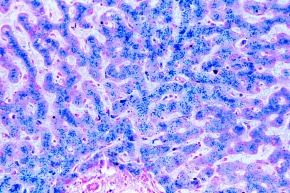 Mikropräparat - Hämosiderosis der Leber. Berlinerblau-Reaktion, Krankhafte Veränderungen der Zellen und Gewebe