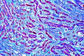 Mikropräparat - Glykoneogenie in der Niere (Glykogen-Niere), Krankhafte Veränderungen der Zellen und Gewebe