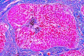 Mikropräparat - Pigmentzirrhose der Leber, Krankhafte Veränderungen der Zellen und Gewebe