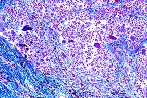 Mikropräparat - Fremdkörper-Granulom mit Hämosiderin und Riesenzellen, Krankhafte Veränderungen der Zellen und Gewebe