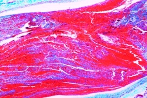 Mikropräparat - Organisierte Venenthrombose im Wadenmuskel, Schädigungen der Kreislauforgane (Herz, Gefäße) und der blutbildenden Organe