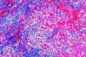 Mikropräparat - Chronische myelische Leukämie der Milz, Schädigungen der Kreislauforgane (Herz, Gefäße) und der blutbildenden Organe