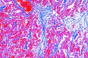 Mikropräparat - Chronische Pneumonie (Pneumonia chronica), Pathologische Veränderungen der Lunge und der Leber, Tuberkulose und Lungenentzündung